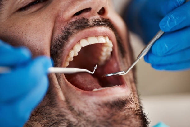 Best Emergency Wisdom Tooth Extraction in North Les, AK